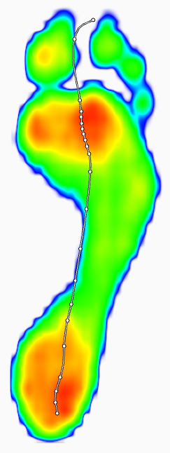 Foot pressure distribution map from a Footscan analysis used for biomechanical assessment and custom Phits insoles.